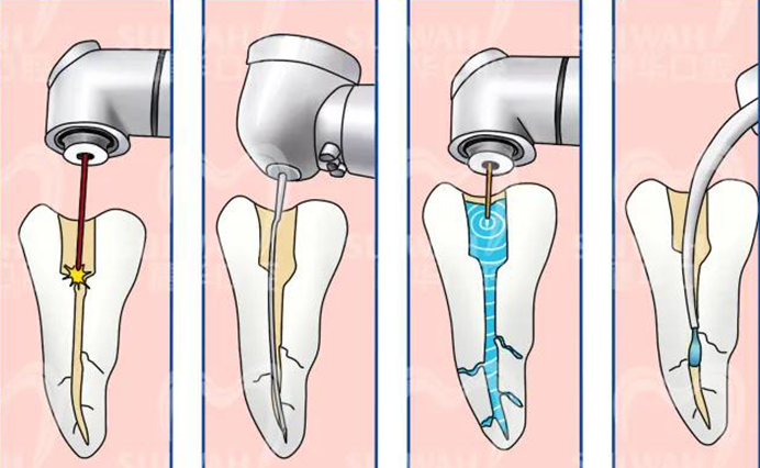 What is the Procedure of Root Canal Treatment?